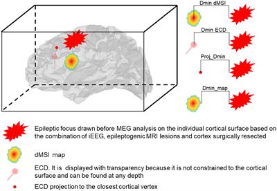 Effects of Independent Component Analysis on Magnetoencephalography Source Localization in Pre-surgical Frontal Lobe Epilepsy Patients